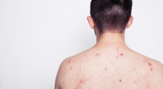 Cốm Subạc – Gạt bỏ nỗi lo bệnh ngoài da do virus