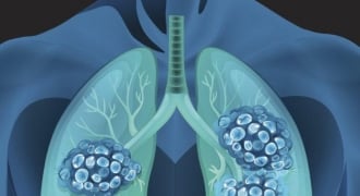 Sản phẩm Tumolung – Giải pháp mới cho người mắc u phổi