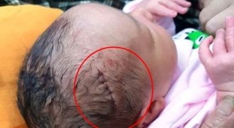 Mổ đẻ, bé sơ sinh bị rách da đầu: “Chúng tôi đã nhắc bác sĩ phải cẩn thận hơn”