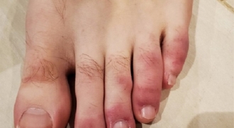 Phát hiện triệu chứng lạ trên ngón chân những bệnh nhân COVID-19