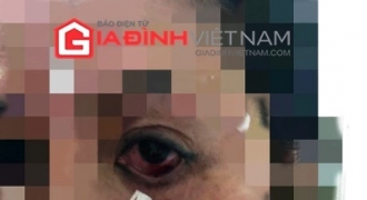 Hà Nội: Bệnh nhân có nguy cơ mù khi cấy chỉ tại Phòng khám tư?