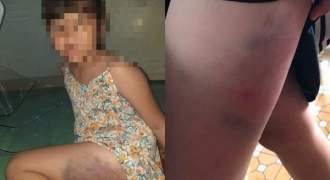 Đắk Lắk: Đình chỉ cô giáo đánh bầm dập bé gái lớp 3