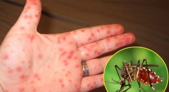 Dấu hiệu bệnh sốt xuất huyết và cách phòng ngừa hiệu quả