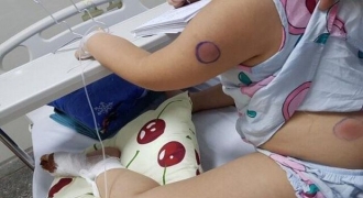 Bé gái Quảng Bình nhiễm “vi khuẩn ăn thịt người” sau khi bị gà mổ vào chân