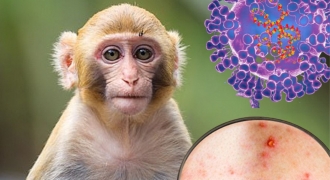 Hơn 21.000 người mắc, đậu mùa khỉ có trở thành đại dịch 
