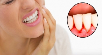 Bệnh viêm quanh răng nguy hiểm không, phòng tránh như thế nào?