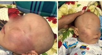 Bé trai 19 tháng tuổi bị bảo mẫu đánh sưng đỏ vì quấy khóc