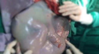 Kỳ lạ: Bé gái song sinh ra khỏi bụng mẹ vẫn còn nguyên trong bọc ối