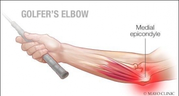 5 phương pháp phục hồi và điều trị chấn thương khuỷu tay cho golfer