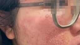 Cầu cứu bác sĩ sau 2 lần dùng món quà Valentine người yêu tặng