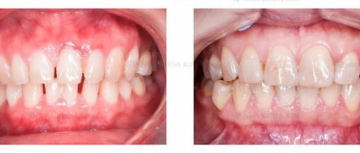 Những lưu ý khi bọc răng sứ