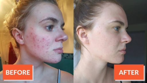 Retinoids – “trùm cuối” trong mỹ phẩm giúp bạn có làn da đẹp