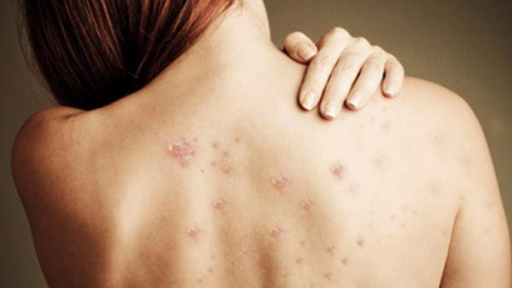 Những nguyên nhân mụn mọc ở lưng