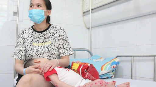 Bệnh tay chân miệng có lây không, ai dễ mắc bệnh?