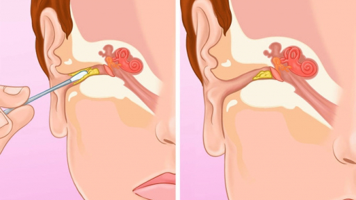 Ngoáy tai bằng tăm bông: Thoải mái một lúc nhưng hại lâu dài