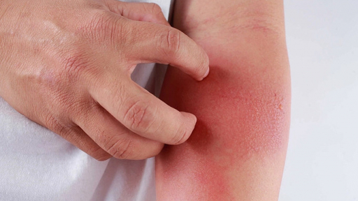 5 dấu hiệu điển hình của người mắc bệnh đậu mùa khỉ