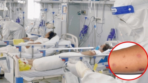 TP.HCM ghi nhận ca đậu mùa khỉ đầu tiên