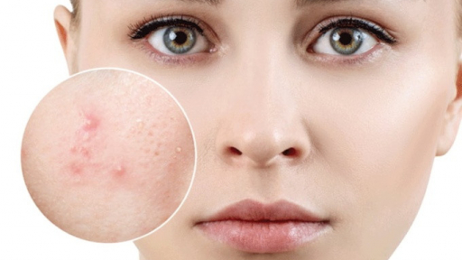 Cách trị mụn ẩn dưới da hiệu quả lên tới 90% ai cũng nên biết