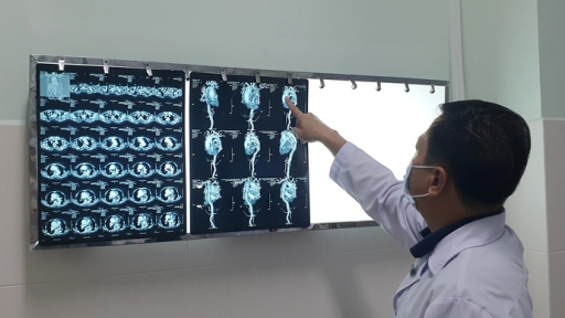 Cứu sống người bệnh vỡ phình động mạch chủ ngực