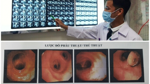 Cần Thơ: Cụ bà nhập viện với chiếc răng giả nằm trong phế quản