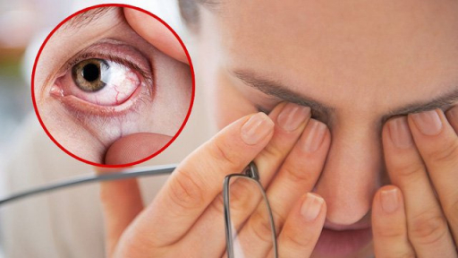 4 cách cải thiện mắt khô và mệt mỏi