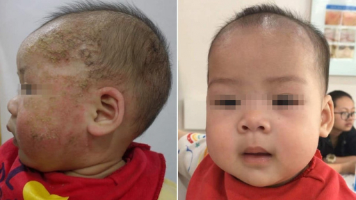 Bé 8 tháng tuổi biến chứng nặng do điều trị viêm da cơ địa bằng tắm lá