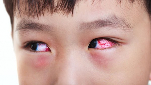 Dịch đau mắt đỏ lan rộng, Cục y tế dự phòng nói gì ?
