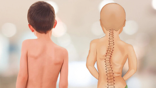 Vẹo cột sống khởi phát sớm ở trẻ nhỏ: Nguyên nhân và dấu hiệu nhận biết