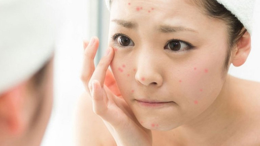 Những loại thực phẩm càng ăn càng khiến bạn lên mụn