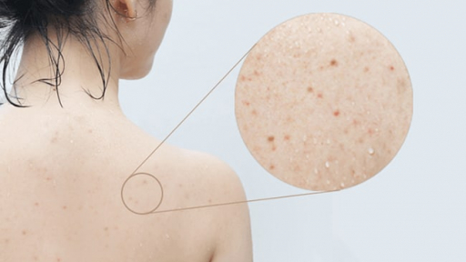 7 nguyên nhân gây mụn lưng, ngực và mụn cơ thể bạn cần biết
