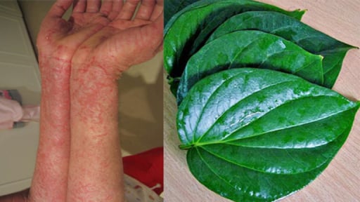 Chữa viêm da cơ địa với các vị thuốc dân gian dễ tìm