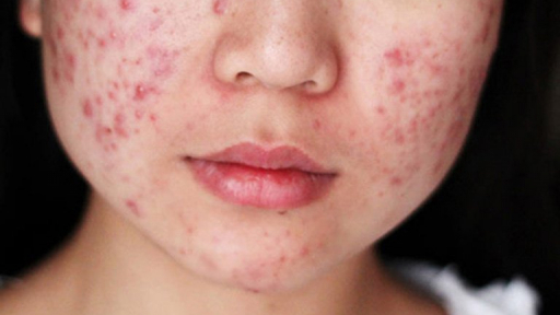 Các loại mụn thường gặp ở tuổi dậy thì