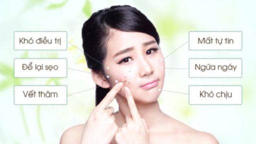 Những điều cần biết về mụn tuổi dậy thì