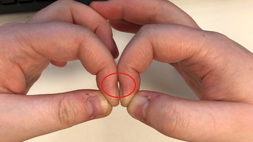 3 dấu hiệu ở ngón tay cảnh báo ung thư phổi