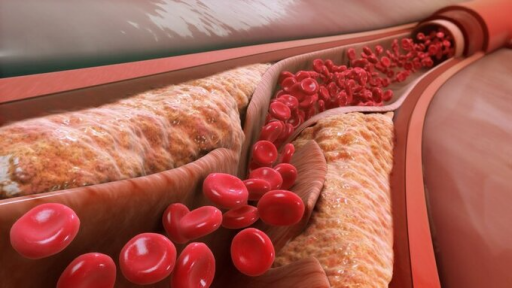Người bị cholesterol cao có nên ăn trứng và thịt?