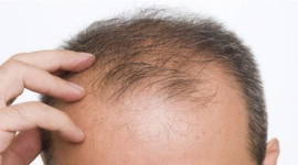 Một số nguyên nhân rụng tóc thường gặp và cách hạn chế