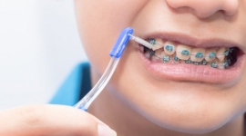 Mách bạn những tip chăm sóc răng miệng khi niềng răng