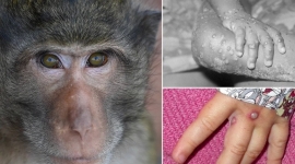 6 biện pháp phòng chống bệnh đậu mùa khỉ