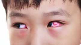 Dịch đau mắt đỏ lan rộng, Cục y tế dự phòng nói gì ?