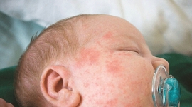 5 bệnh thường gặp ở trẻ nhỏ trong mùa nắng nóng