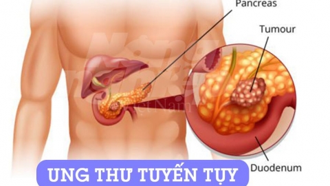 Ung thư tuyến tụy là gì? Nguyên nhân và dấu hiệu bệnh