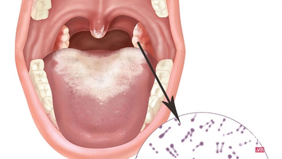 Bệnh bạch hầu không đáng sợ như Covid-19