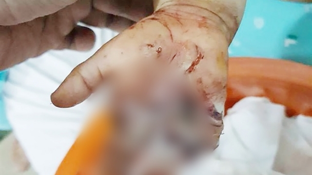 Nghịch xích xe máy đang quay, bé trai 2 tuổi bị đứt lìa ngón tay