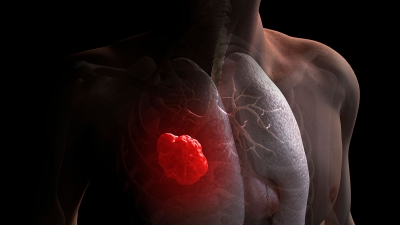 Những điều cơ bản cần biết về ung thư phổi