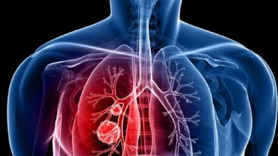 Những điều cần biết về ung thư phổi giai đoạn III và hóa trị liệu