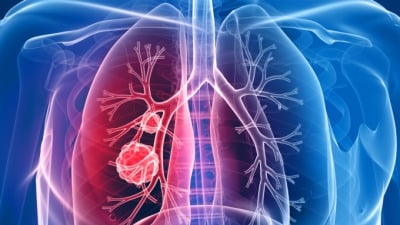 Triệu chứng và chẩn đoán ung thư phổi