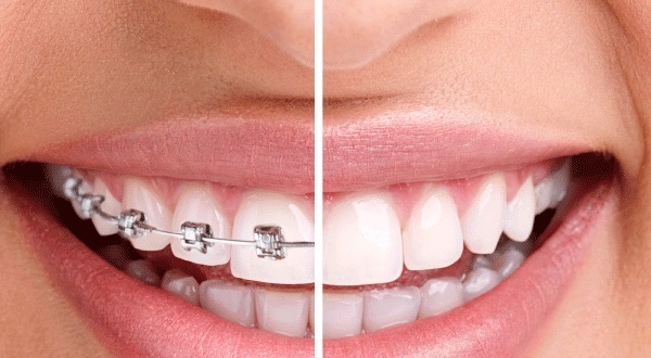 10 điều chuyên gia khuyến cáo khi niềng răng, chỉnh nha