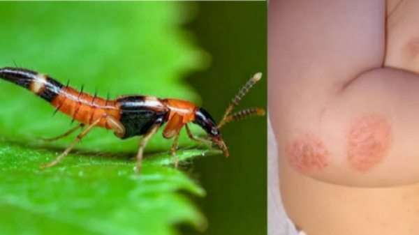 Viêm da tiếp xúc do kiến ba khoang - nỗi lo khi mùa hè đến