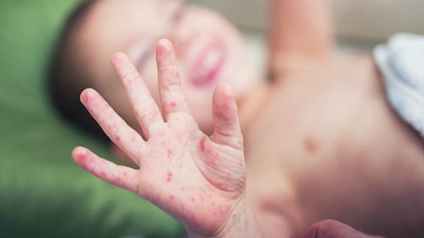 Bệnh chân tay miệng tại Đắk Lắk đang gia tăng
