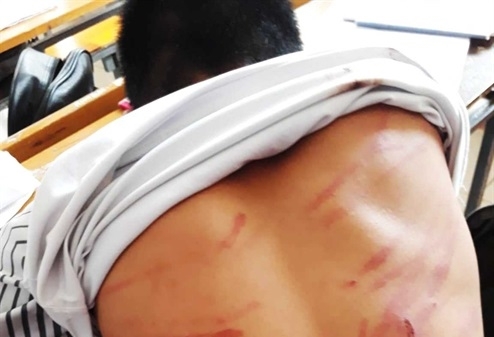 Hà Tĩnh: Phẫn nộ một học sinh lớp 8 bị bố đẻ đánh đập dã man